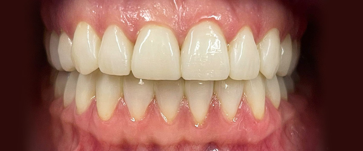 Ładne zęby, czyli jakie? #DŁUGOŚĆ siekaczy centralnych